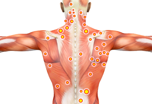 Trigger Points.